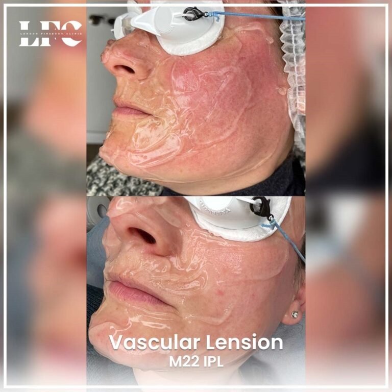 vascular-lension-treatment-in-london