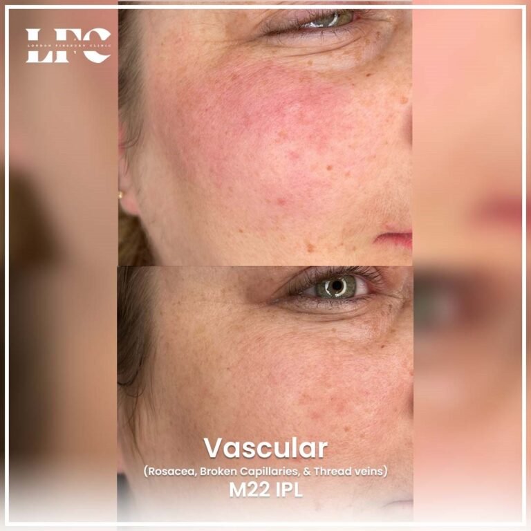 vascular-treatment-in-london