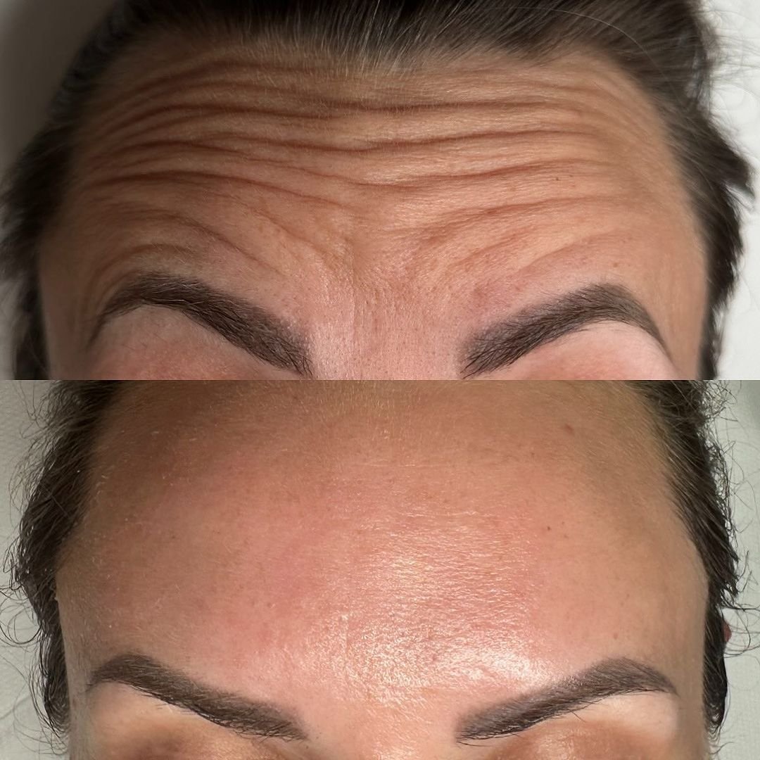 anti-wrinkle-after-finsbury