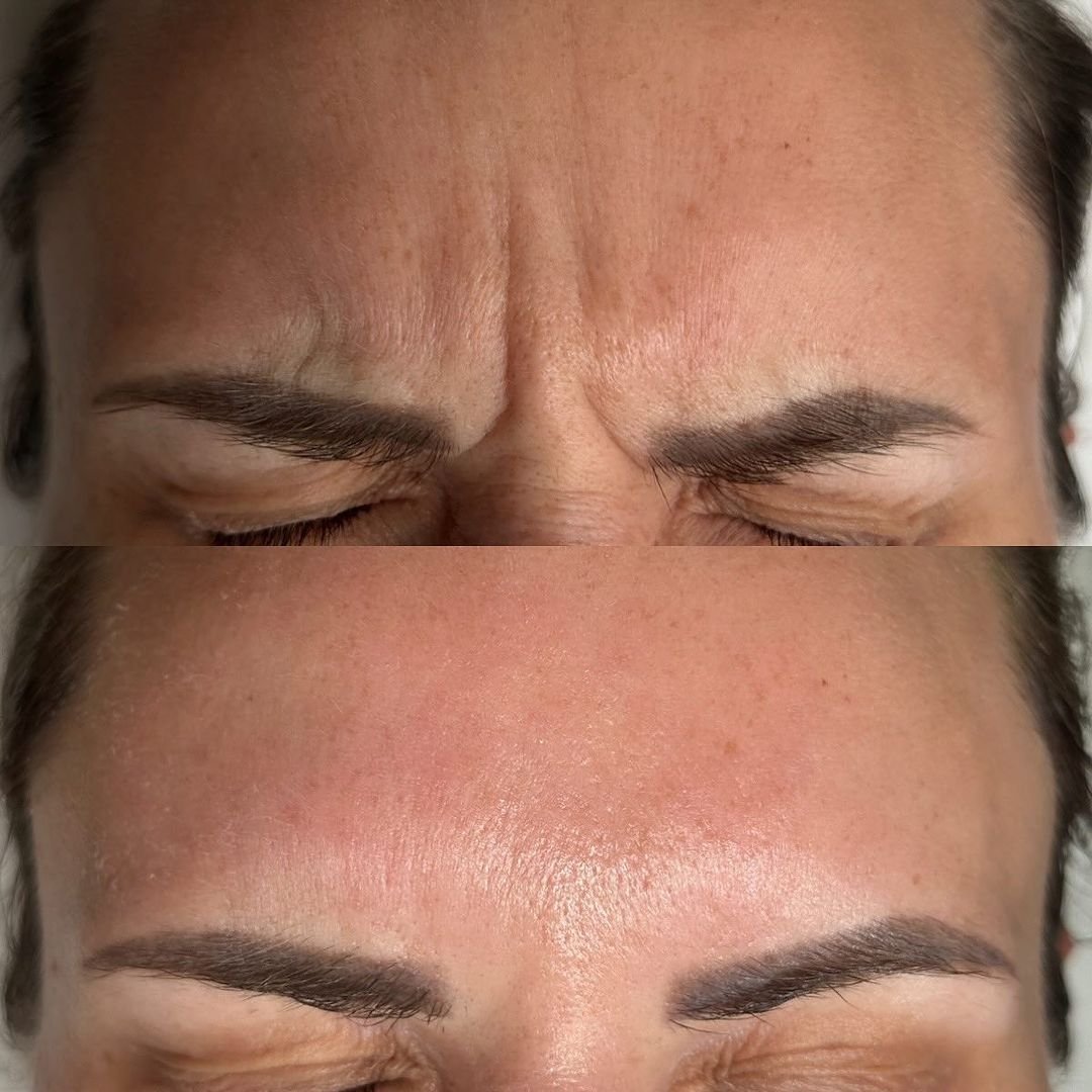 anti-wrinkle-before-finsbury