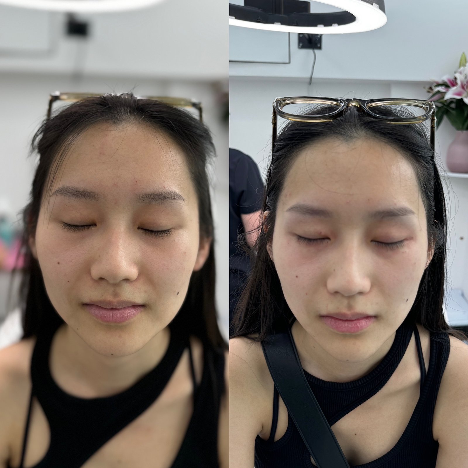 masseter-slimming-before-after-london-finsbury-clinic-in-london-uk.JPG